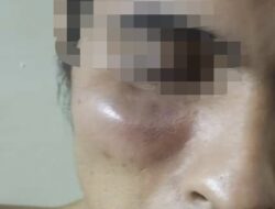 Pemuda Wiladeg Alami Luka Bengkak Usai Dipukul Tetangga di Rusunawa Karangrejek, Kasus Dilaporkan ke Polisi