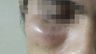 Pemuda Wiladeg Alami Luka Bengkak Usai Dipukul Tetangga di Rusunawa Karangrejek, Kasus Dilaporkan ke Polisi